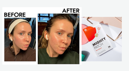 Do Mighty Patches Work on Under-Skin Pimples