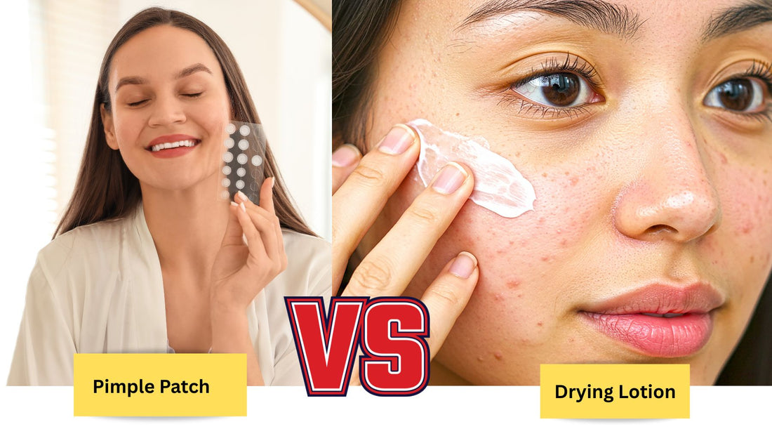 pimple patch vs drying lotion