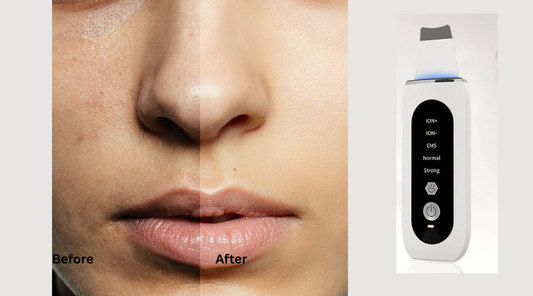 ultrasonic skin spatula before and after