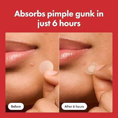 Hydrocolloid Pimple Patches – Day & Night